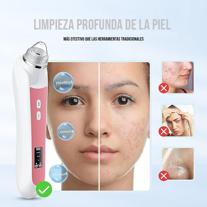 Limpieza Facial Profesional en Casa – Removedor de Puntos Negros con Cámara HD